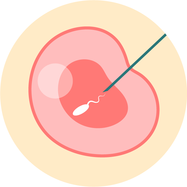 Mikroiniekcja plemnika do komórki jajowej – ICSI